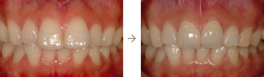 前歯が前に出ているのを普通に戻して小さくしています