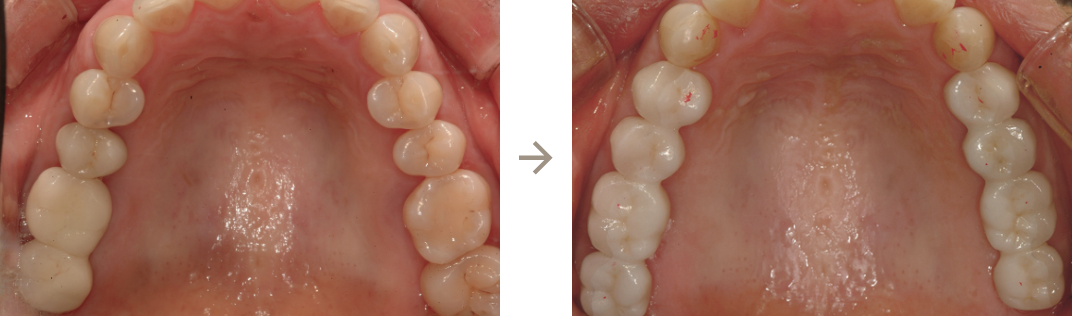 歯周病がひどく奥歯を抜歯ブリッジにしています