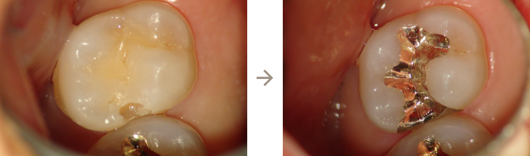 一番奥の歯と歯の間にむし歯ができて詰め物にしています